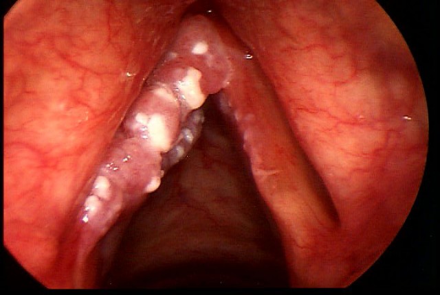 cancer larigas